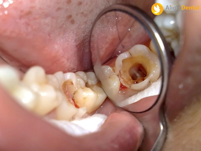 Răng bị hư và sâu nặng cần phải lấy tủy ra trước khi trám
