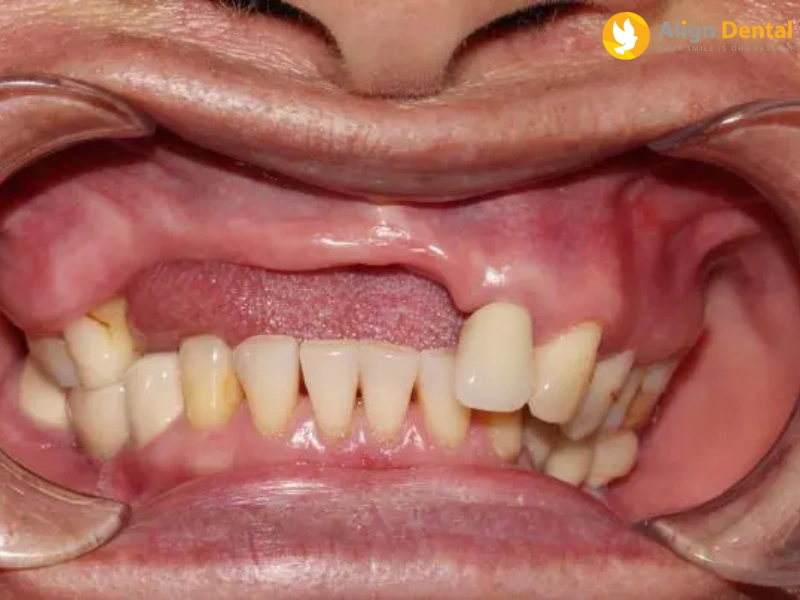 trồng răng sứ không có chân răng giả bao nhiêu