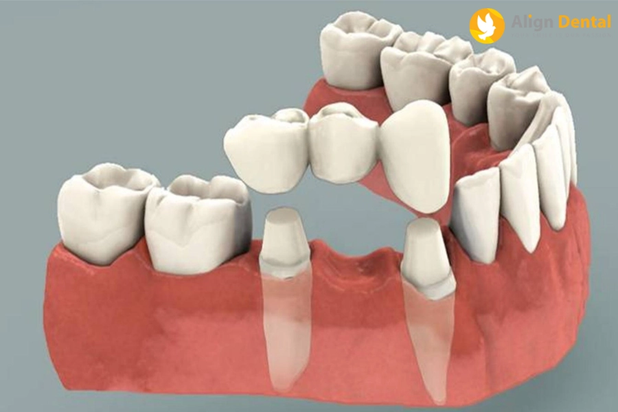 [Giải Đáp] Trồng Răng Giả Có Ảnh Hưởng Gì Không?