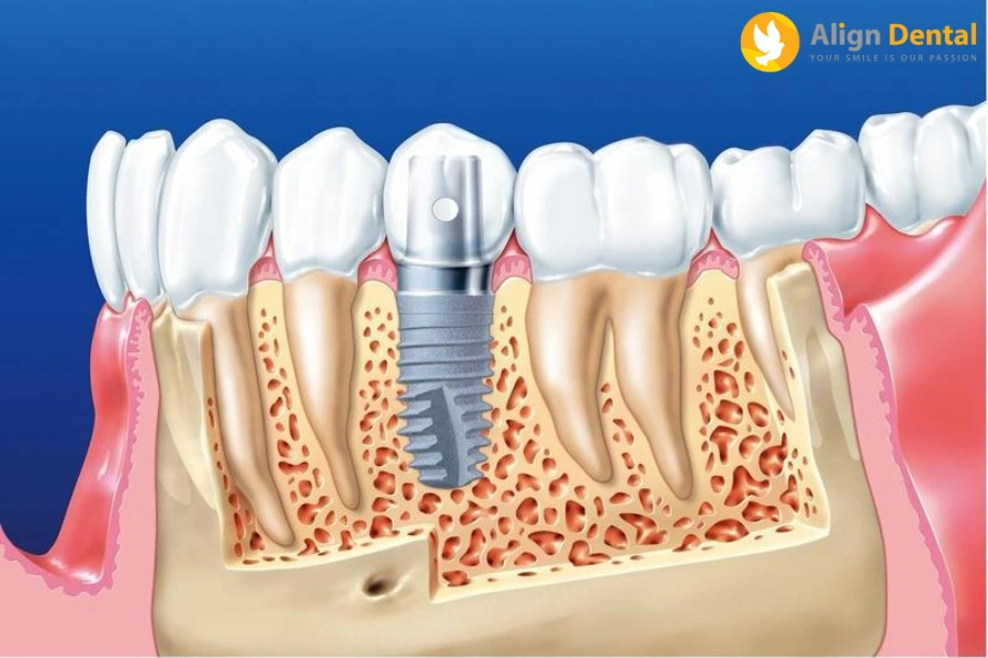 Phương Pháp Trồng Răng Implant Là Gì? Có Những Ưu Điểm Gì Nổi Bật