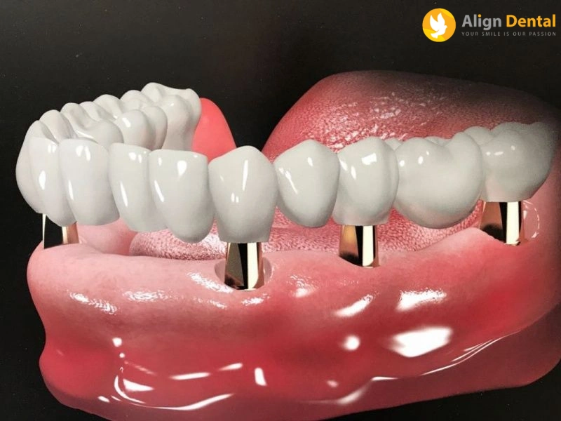 răng implant sử dụng được bao lâu