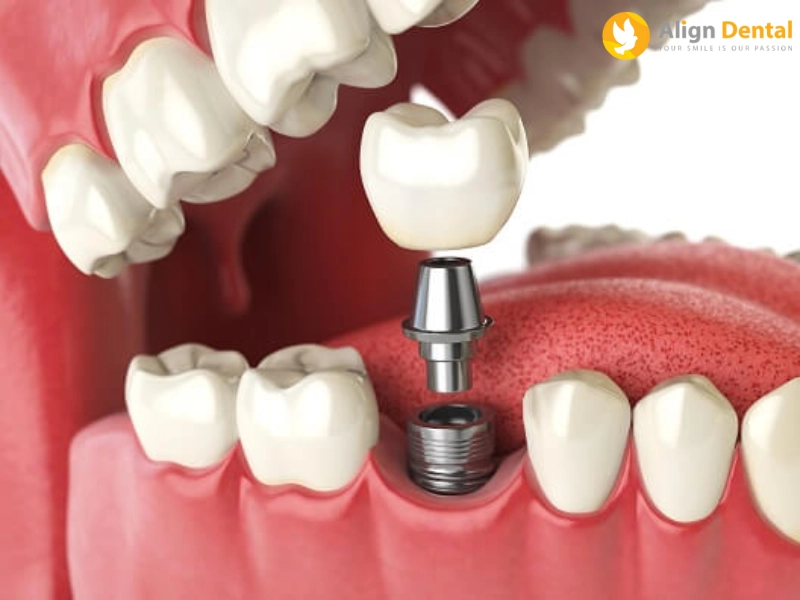 Trồng răng mini Implant có khác biệt gì so với Implant thông thường?