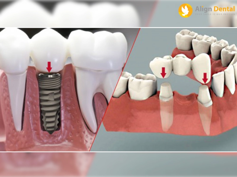 Có nên thay cầu răng sứ bằng răng implant không?