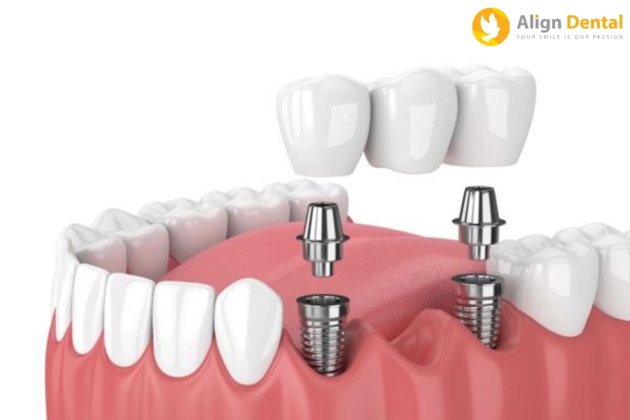 Trồng Răng Implant Mất Bao Lâu Thì Hoàn Thành