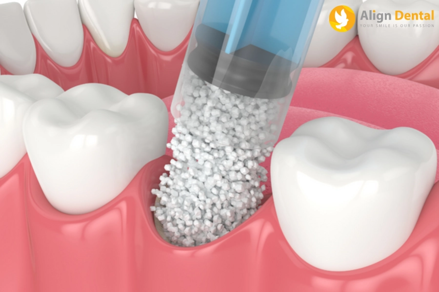 Tìm Hiểu Về Phẫu Thuật Ghép Xương Răng Khi Cấy Ghép Implant