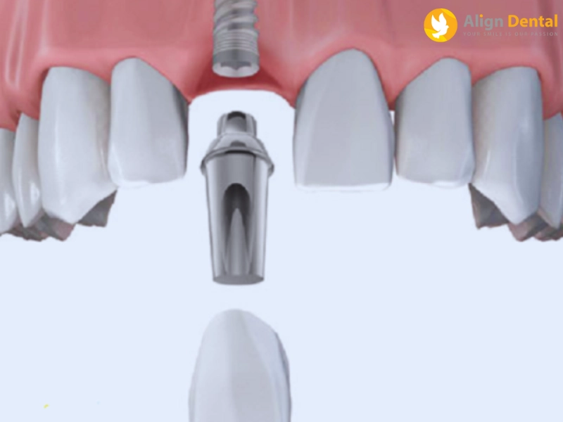 Trồng răng cửa Implant