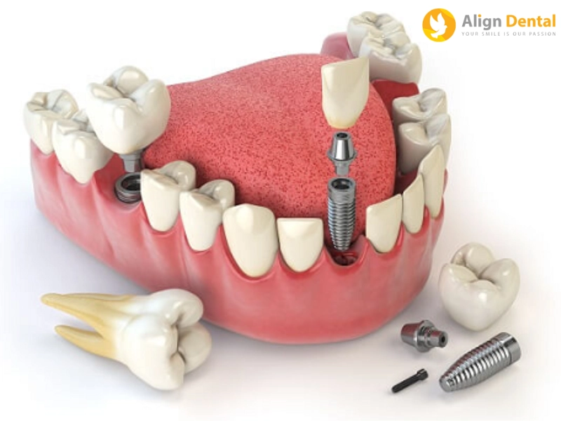 Quy trình thay cầu răng sứ bằng răng implant