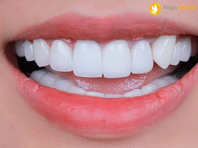 Trồng răng giả giúp tăng tính thẩm mỹ cho tổng thể gương mặt
