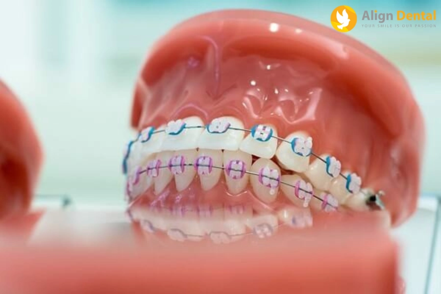 [Giải Đáp] Trồng Răng Implant Có Niềng Răng Được Không?