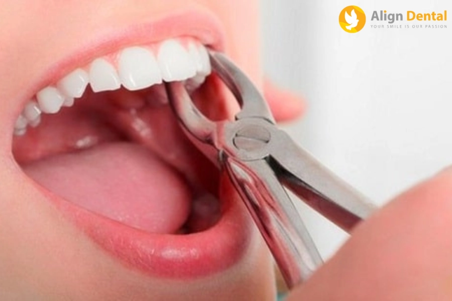 [Giải Đáp] Niềng Răng Có Phải Nhổ Răng Không?