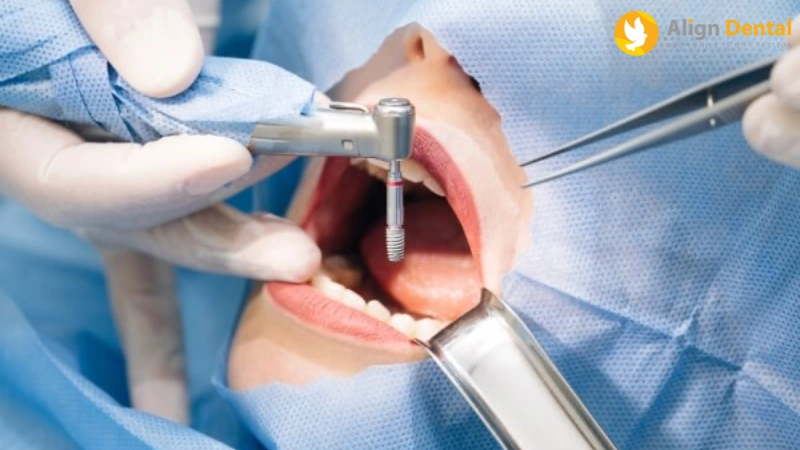 tuổi thọ răng implant