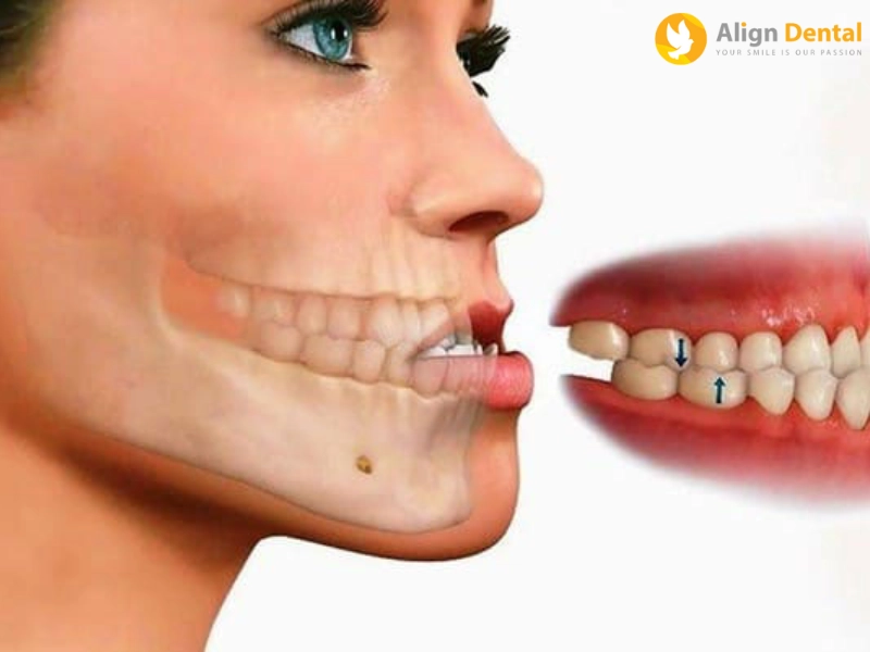 răng móm là gì