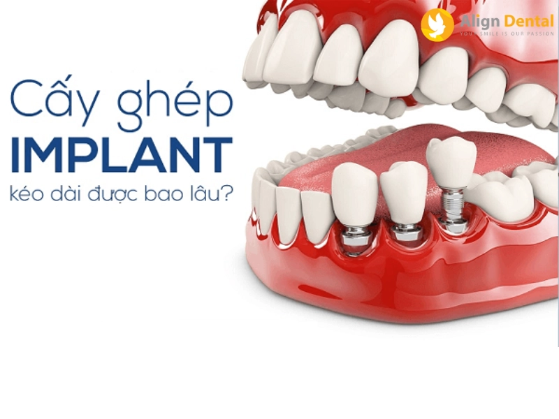 răng implant sử dụng được bao lâu