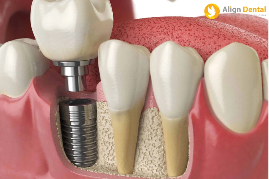 #Khi Nào Nên Trồng Răng Implant - Ưu, Nhược Điểm Là Gì?