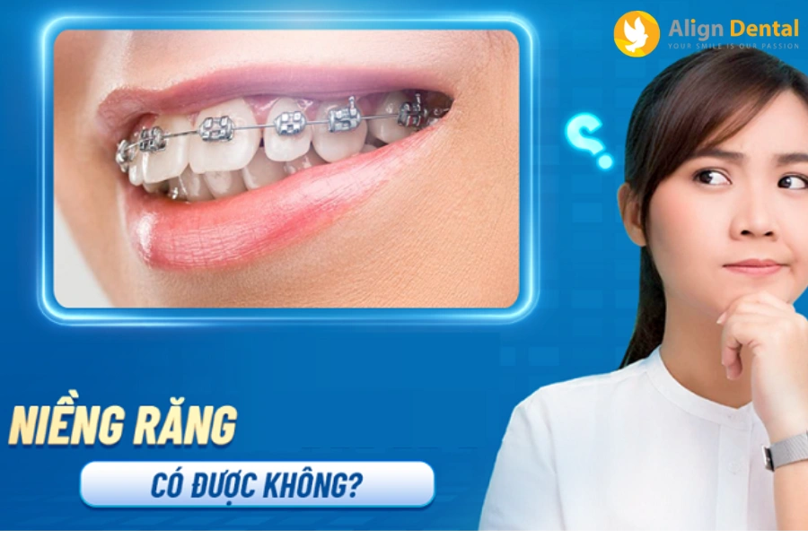 20 Tuổi Có Niềng Răng Được Không? Chi Phí Niềng Là Bao Nhiêu?