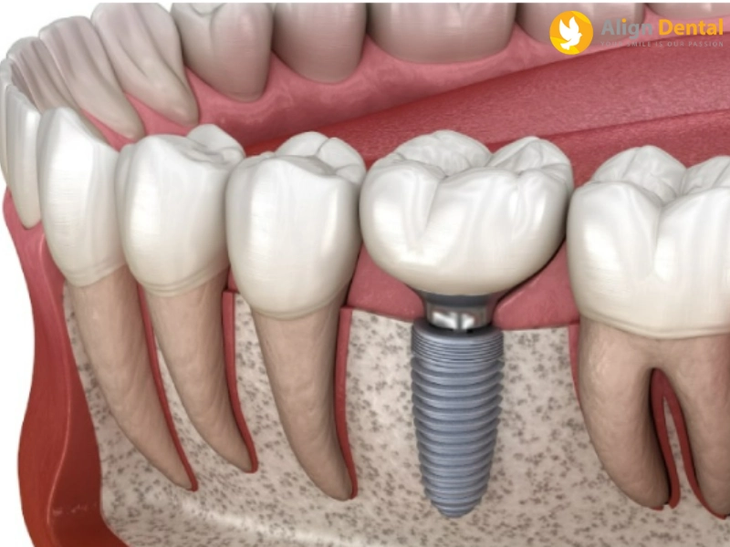 align dental địa chỉ cấy ghép implant chất lượng với mức giá cực kỳ ưu đãi
