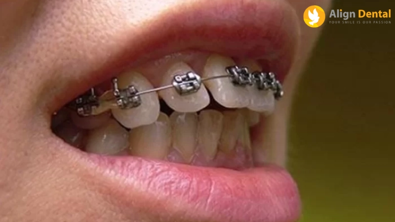 niềng răng 1 hàm