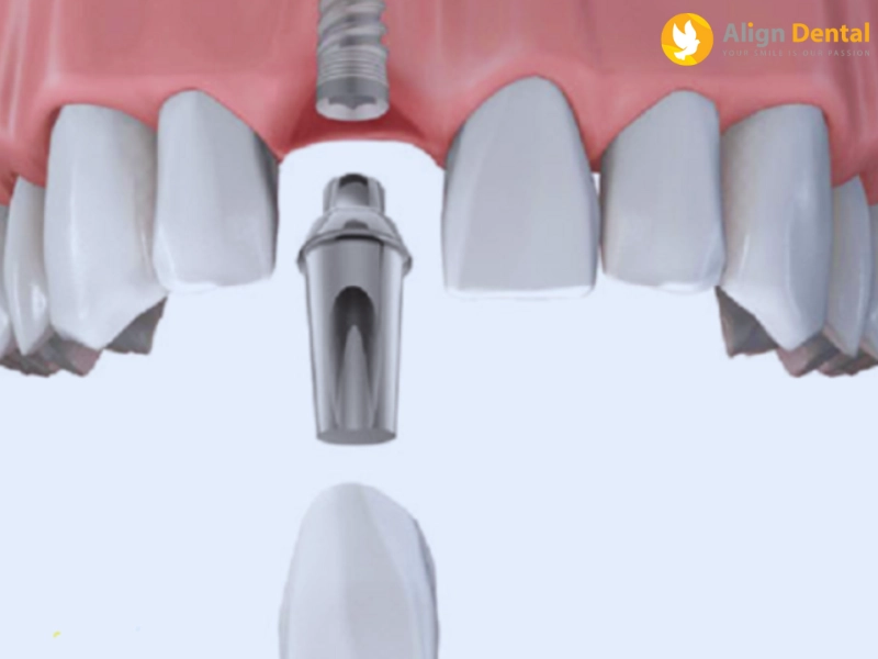 trồng implant răng cửa