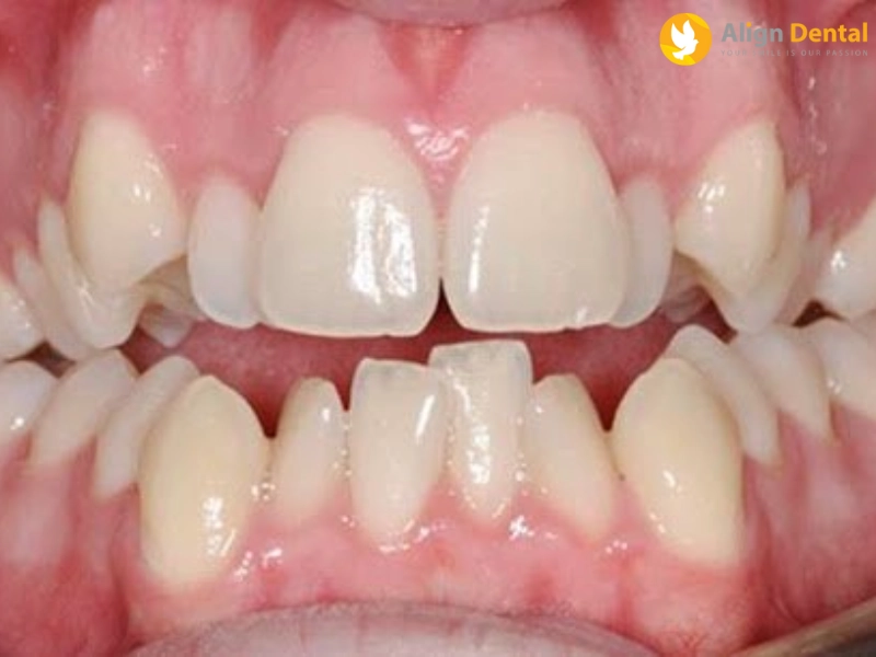 răng khểnh hàm dưới