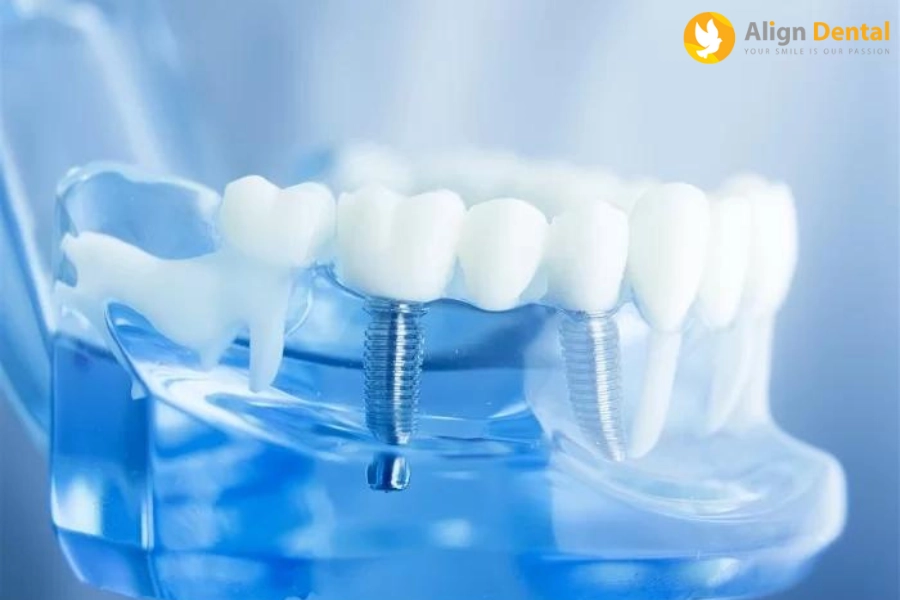 Chính Sách Trồng Implant Trả Góp - Lãi Suất 0% Tại Nha khoa Align Dental