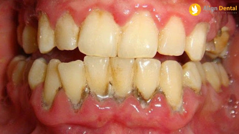 Điều trị viêm quanh răng (Nha Chu)
