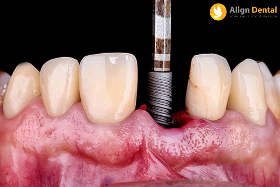 Trồng Răng Implant Có Nguy Hiểm Không? Có Gây Biến Chứng Không?