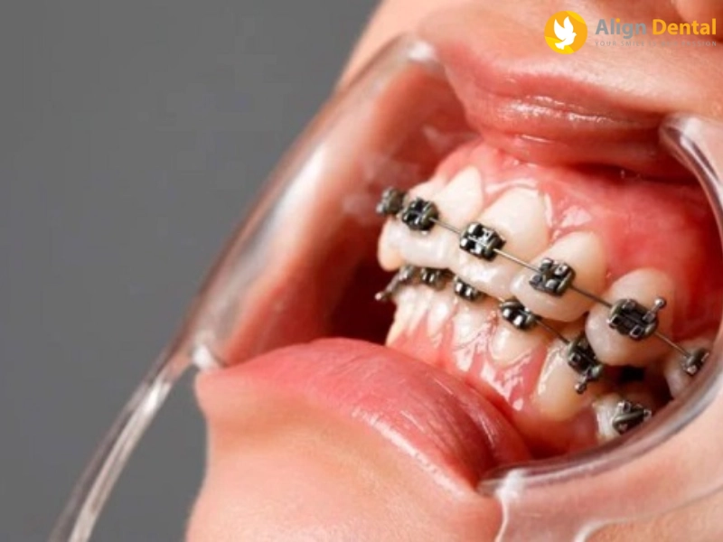 siết răng là gì