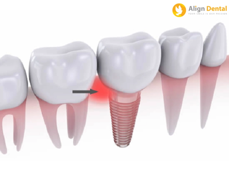 Răng implant bị viêm do lây nhiễm chéo giữa các răng