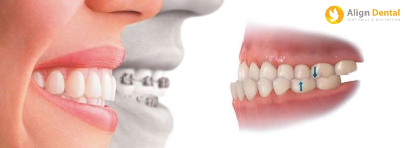 răng móm là gì