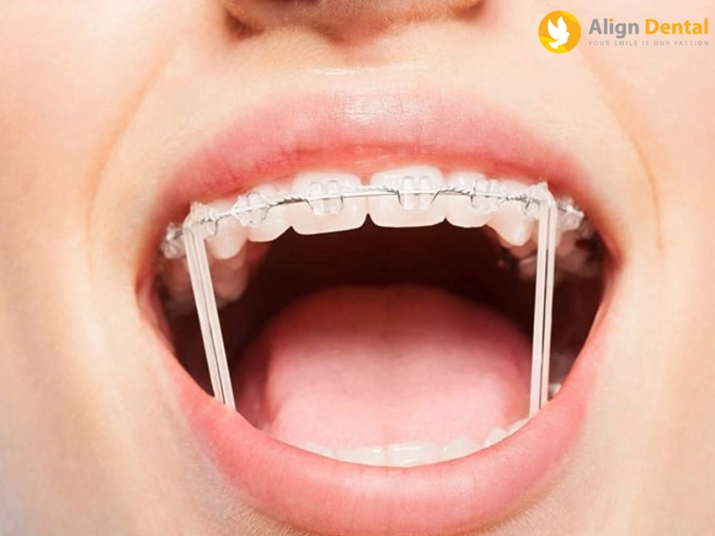 các loại dây thun trong niềng răng