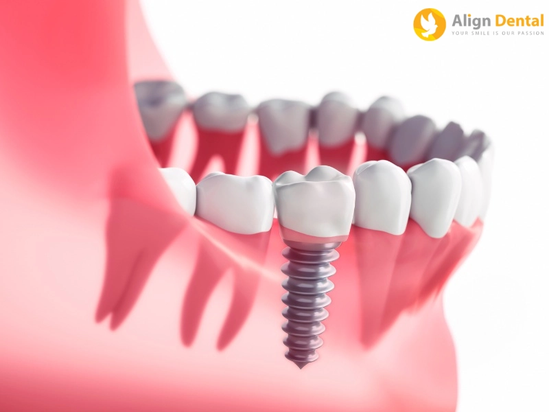 Trồng răng cấm implant giá bao nhiêu?
