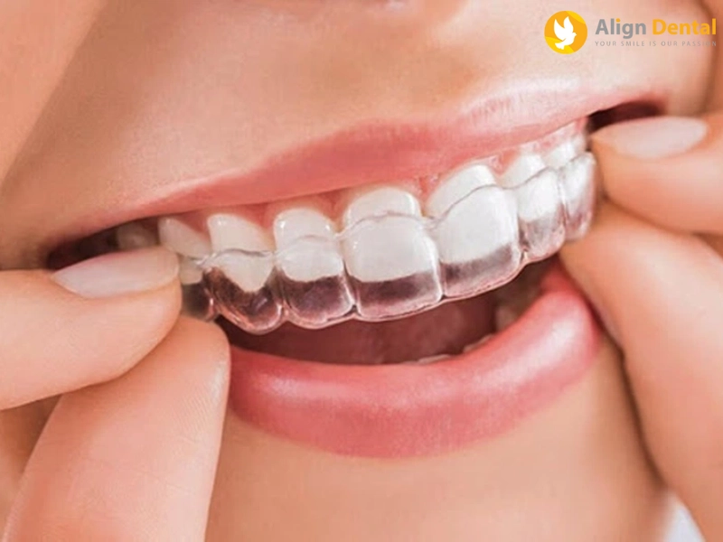 ưu điểm của niềng răng invisalign