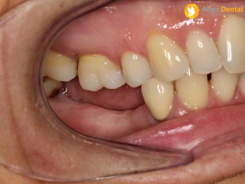 Mất răng bao lâu thì bị tiêu xương hàm