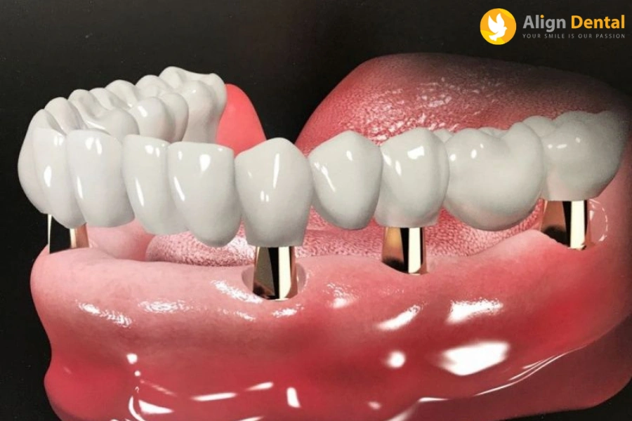 Tuổi Thọ Răng Implant Sử Dụng Được Bao Lâu?