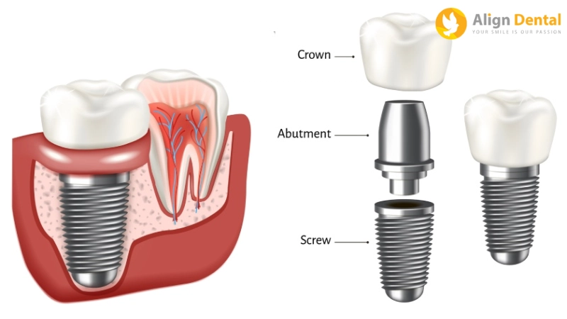 phục hình răng sứ trên implant