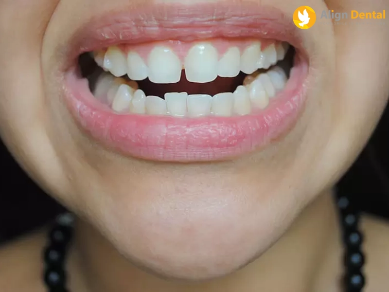 Răng bị lệch sau khi niềng răng