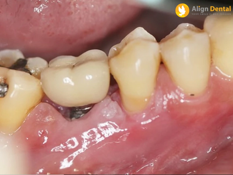tác hại của việc trồng răng implant