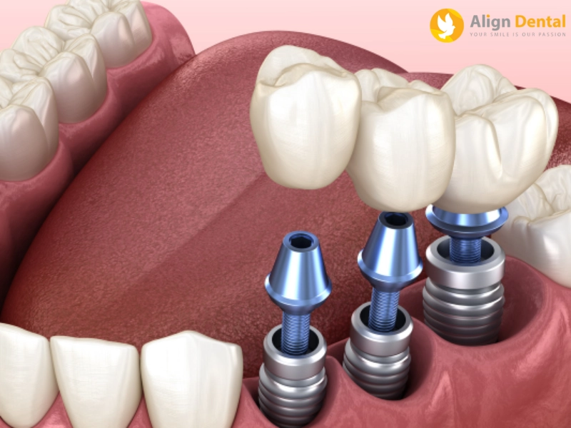 Cách điều trị răng Implant bị viêm