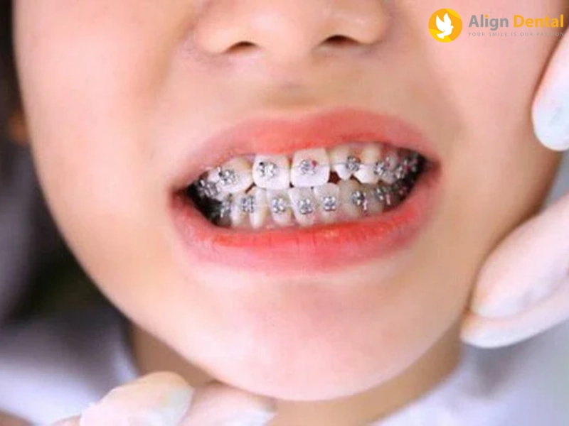 siết răng là gì