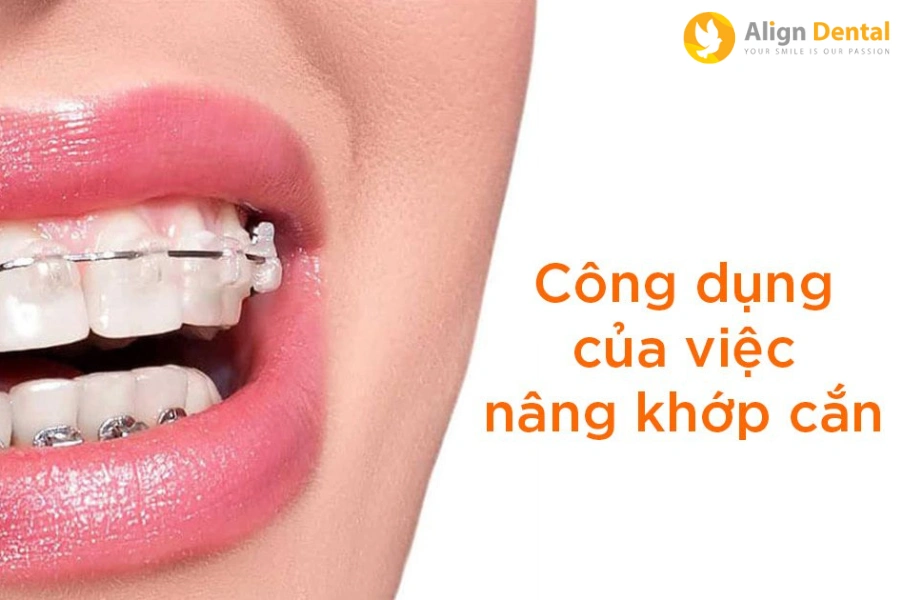 [Giải Đáp] Nâng Khớp Cắn Trong Niềng Răng Có Tác Dụng Gì?