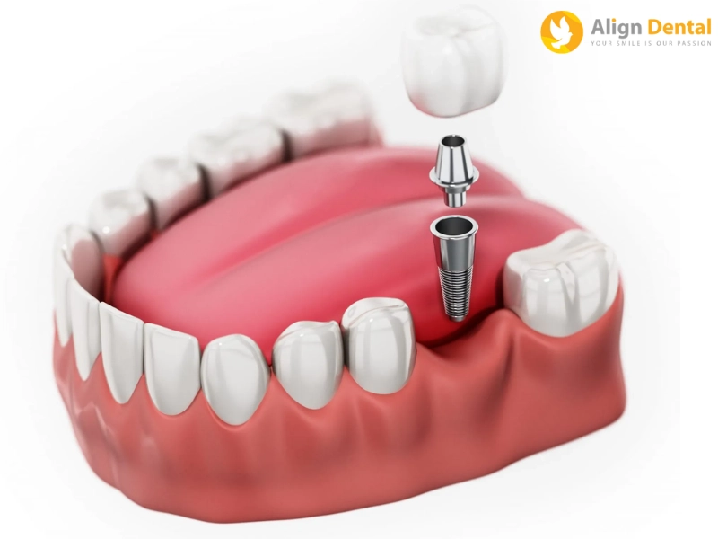 Trồng 3 răng liên tiếp bằng phương pháp trồng răng Implant