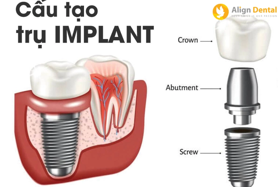 Cấu Tạo Trụ Implant Như Thế Nào? Đâu Là Chi Tiết Quan Trọng Nhất