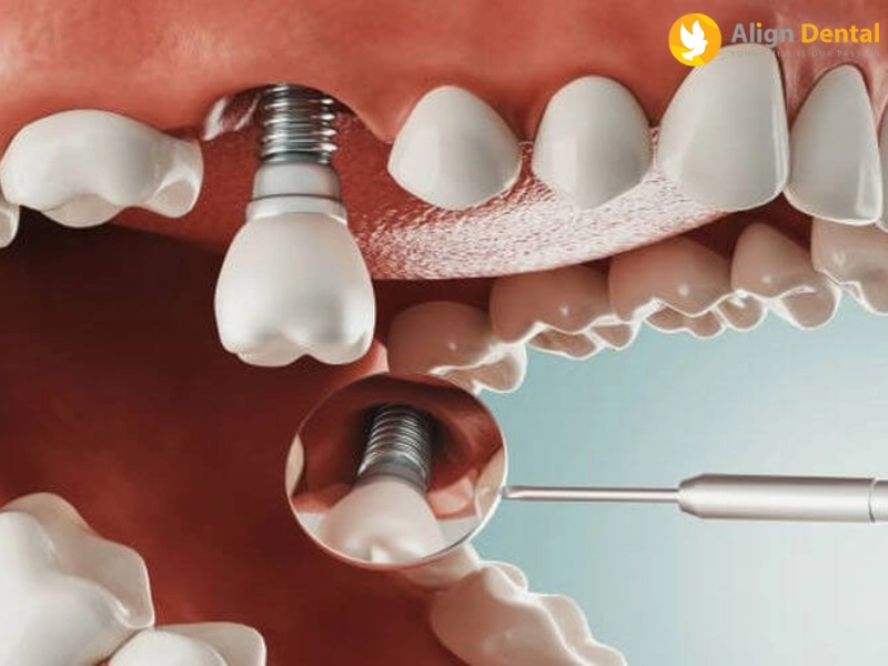 Thăm khám bác sĩ nha khoa trước khi quyết định trồng răng Implant