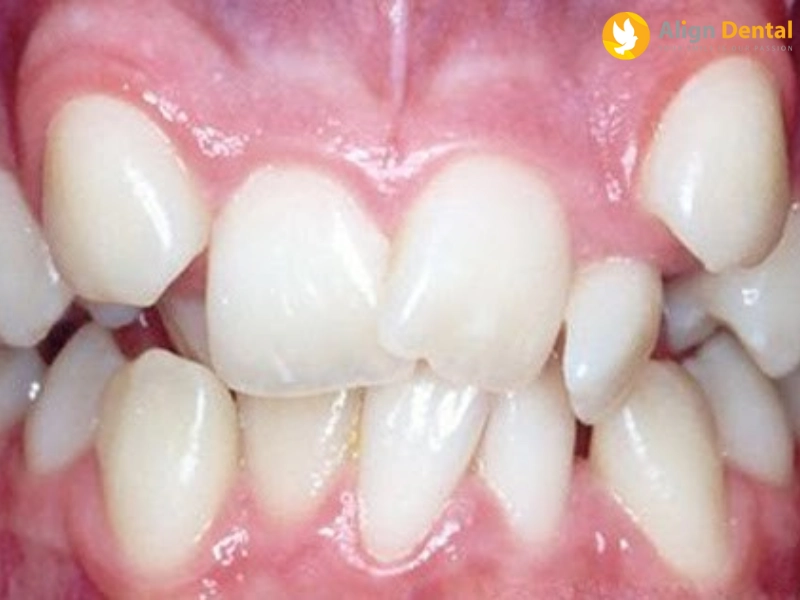 răng lòi xỉ là gì