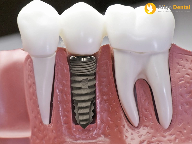 Lưu ý gì khi trồng răng implant?