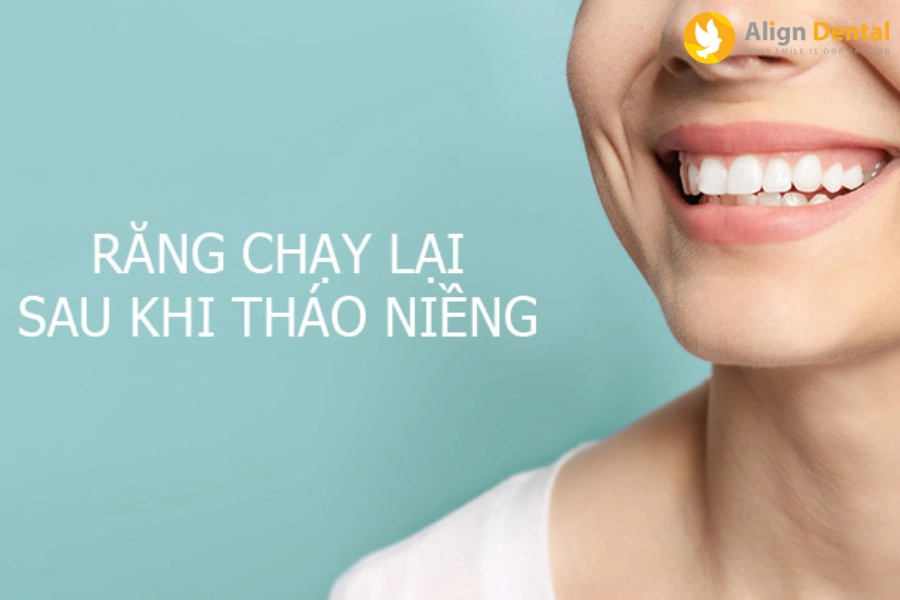 Niềng Răng Xong Có Bị Chạy Lại Không? Lý Do Vì Sao Và Cách Khắc Phục