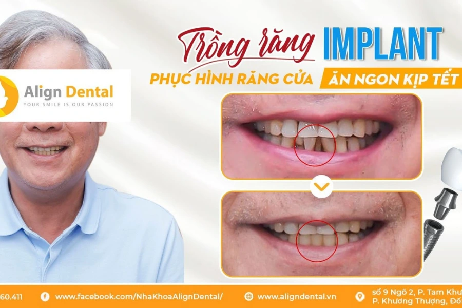 Top 5+ Địa Chỉ Trồng Răng Implant Hà Nội Uy Tín Tại Align Dental