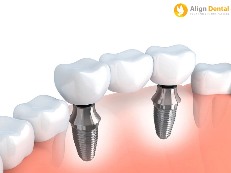 Tại sao chọn trụ implant mỹ để trồng răng implant?