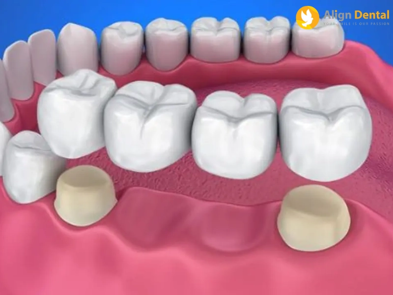 Răng tạm Implant là giải pháp phục hình răng tạm thời