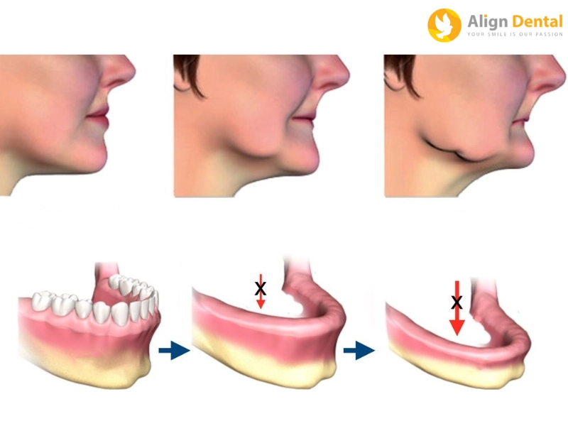 Răng tiêu xương hàm có trồng răng được không?